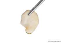 Bone Regeneration for Implants Understanding the Process and Benefits