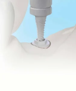 Dental Implant 2