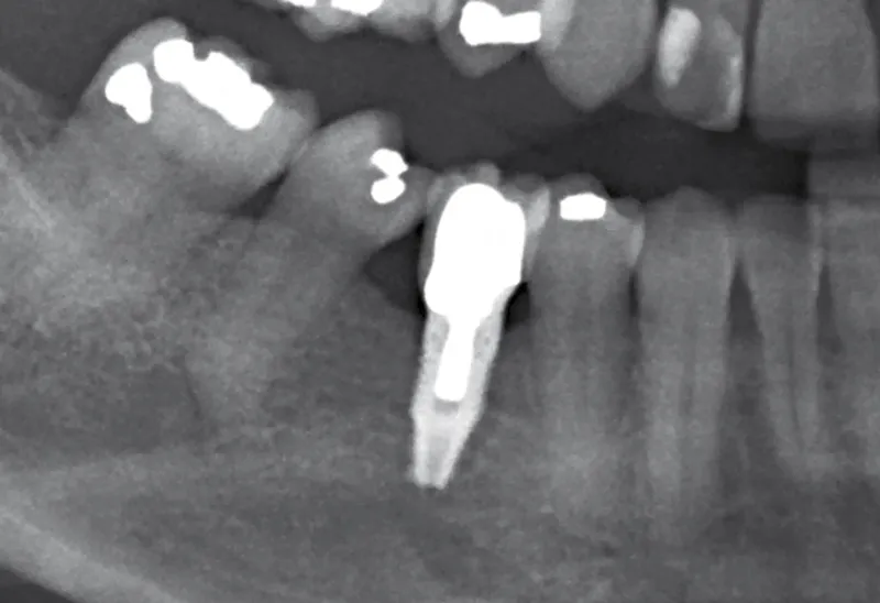 Dental bone loss 1