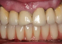 Dental Bridge Duration: Understanding How Long They Last