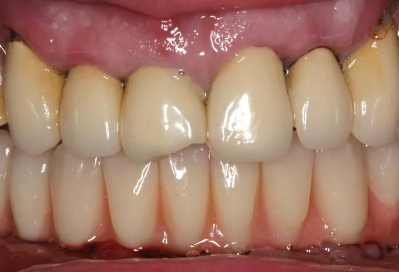 Dental bridge duration 1