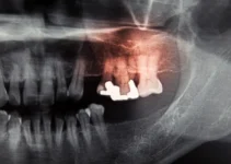 Dental Bridge Problems and How They Affect Oral Health