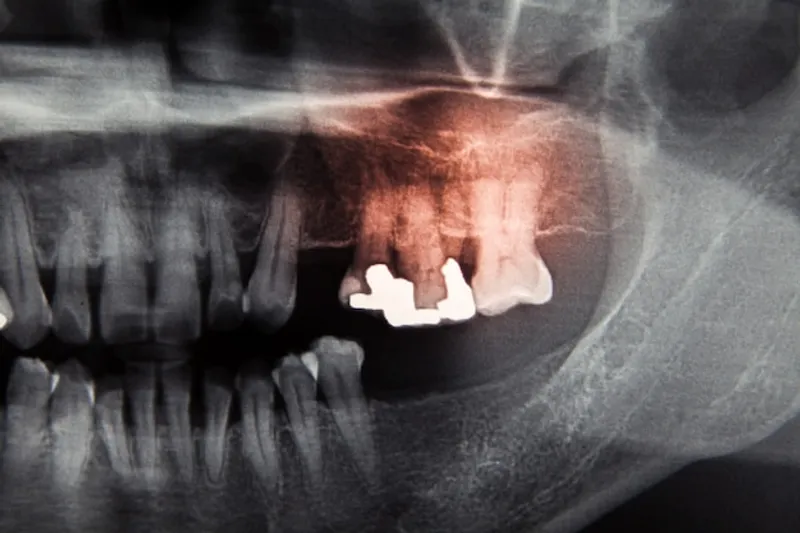 Dental bridge problems 1