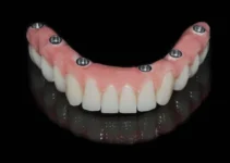 Dental Bridge vs. Implant – Understanding Your Options for a Fuller Smile