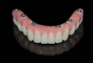 Dental bridge vs. implant 2