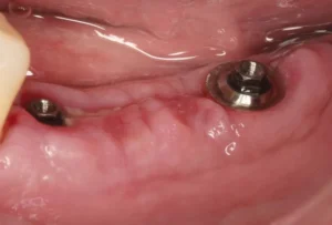 Dental implant gum problems 1