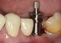 Dental Implant Infection Causes and Prevention Strategies