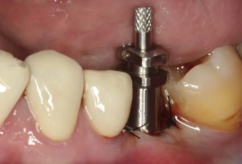 Dental implant infection 1