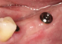 Dental Implant Problems and How to Avoid Them