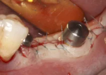 Dental implant pus – Understanding Causes and Prevention