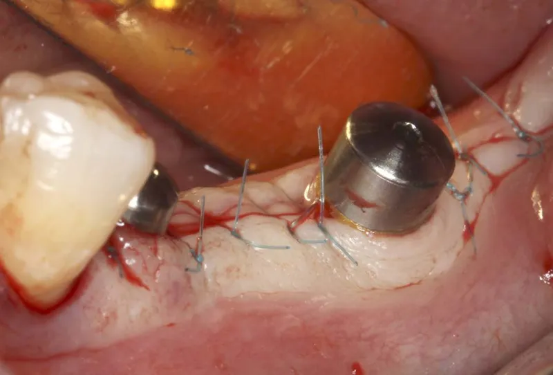 Dental implant pus 2