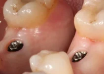 Dental Implant Red Gums – Understanding Causes and Solutions