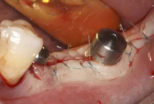 Dental implant rejection 2