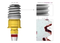 Dental Implant with Insufficient Bone Solutions and Expert Opinions