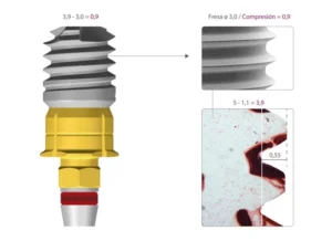 Dental implant with insufficient bone 1