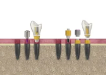 Dental Implants – Essential Information Before You Decide