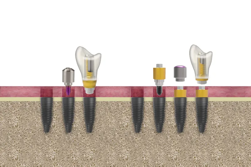 Dental implants Everything you need to know before deciding 2