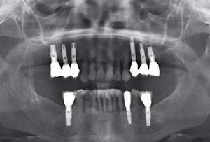 Dental implants with little bone 1