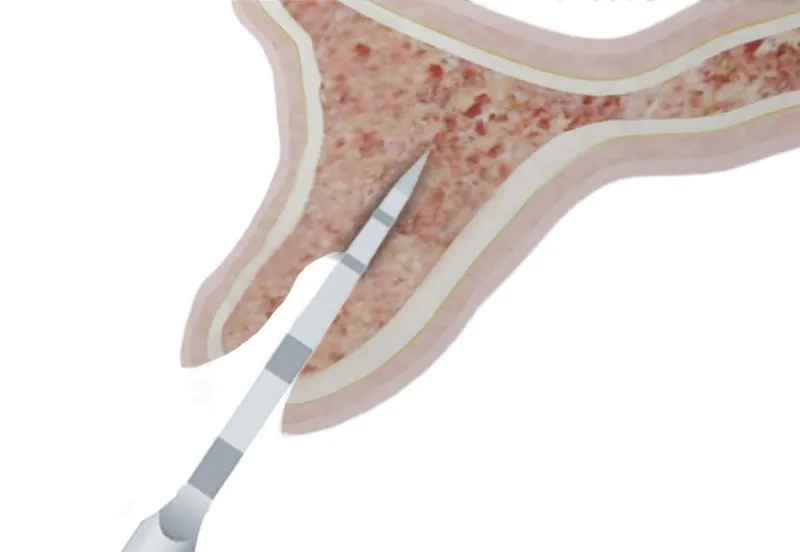 Endodontics The step by step procedure to save your tooth 1