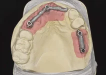 Fixed dental bridge options and their benefits for missing teeth