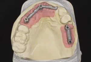 Fixed dental bridge 1