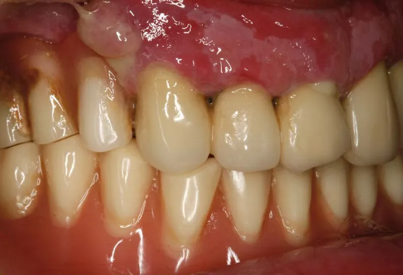 Gum recession Causes consequences and treatments 2