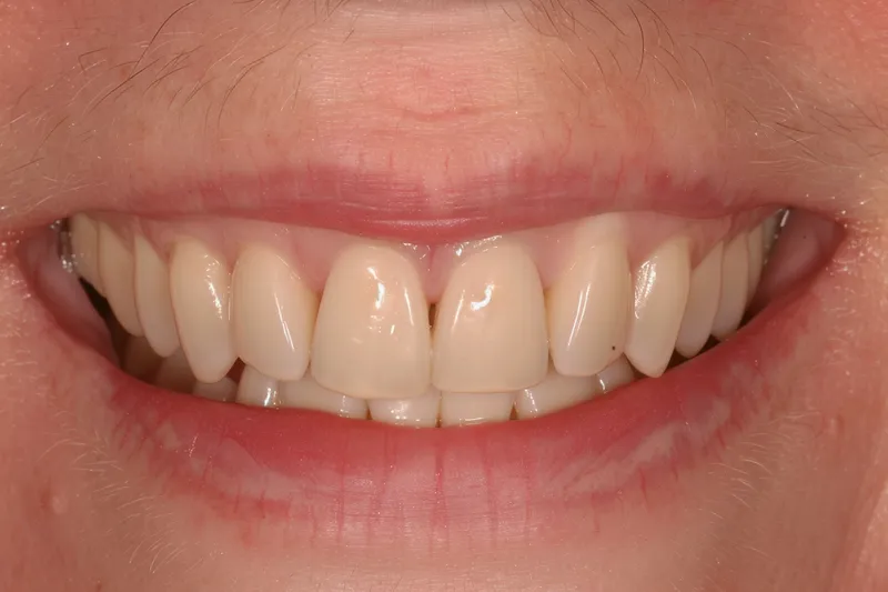 gum recession causes, consequences, and treatments explored