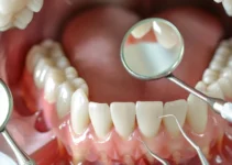 Innovative Treatments for the Reconstruction of Tooth Enamel Explained