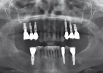 Jaw Bone Deficiency Causes and Treatment Options