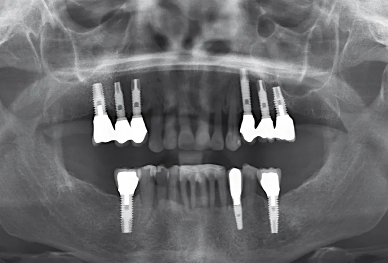 prevention of drug-associated osteonecrosis of the jaws: essential strategies