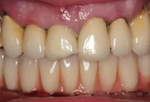 Removable partial denture 1