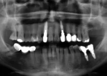 The Role of Dental Radiography in Dental Diagnosis and Treatment Explained