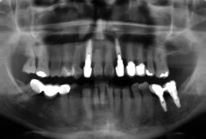 The role of dental radiography in dental diagnosis and treatment 2