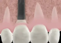 What is a Dental Crown and When Do You Need It? Understanding Its Purpose and Benefits