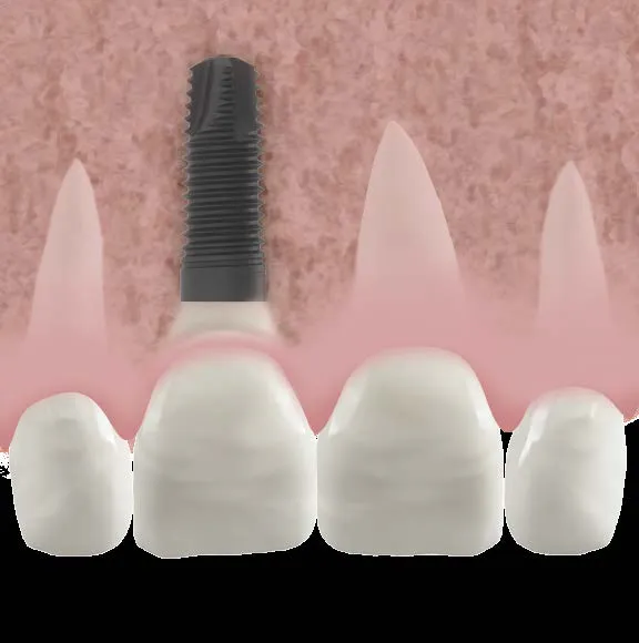 What is a dental crown and when do you need it 2