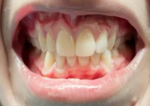 Acute Gingivitis Explained – Symptoms, Causes, and Prevention Strategies