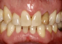 Crooked Teeth Causes and Solutions for Misaligned Smile