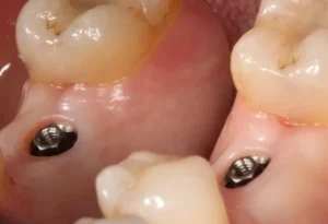 dark gums around the implant 1