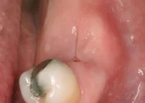 Gum abscess understanding causes and symptoms