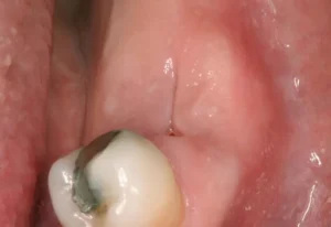 gum abscess 2