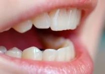 Gums Around the Implant Bleed: Understanding Causes and Solutions