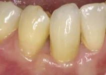 How to Remove Tartar from Teeth Effectively Without Professional Help