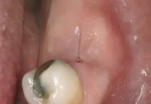 infected tooth 1