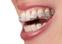 Mandibular Advancement Device Explained – Benefits and Uses for Snoring and Sleep Apnea