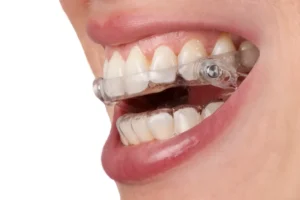 mandibular advancement device 1