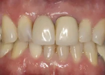 Porcelain Veneers Price Factors and Considerations