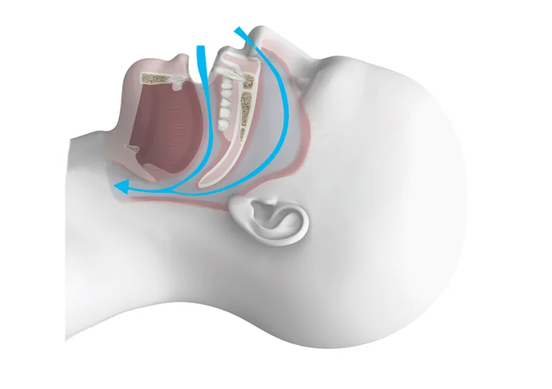 sleep apnea tonsils and their role in breathing disruptions