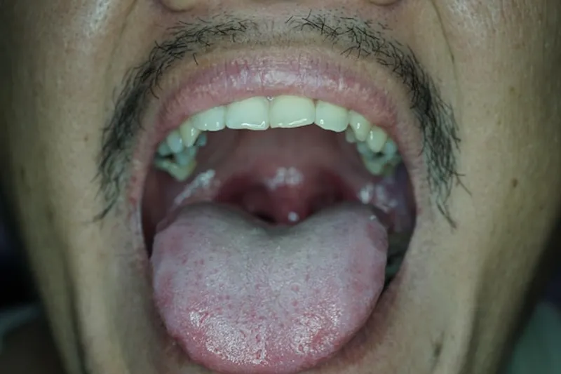 tongue infection 1