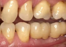 Yellow teeth causes and how to prevent them